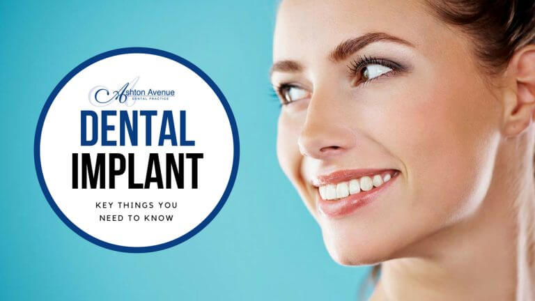 Dental Implants