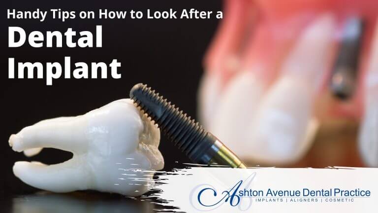 How to look after a dental implant