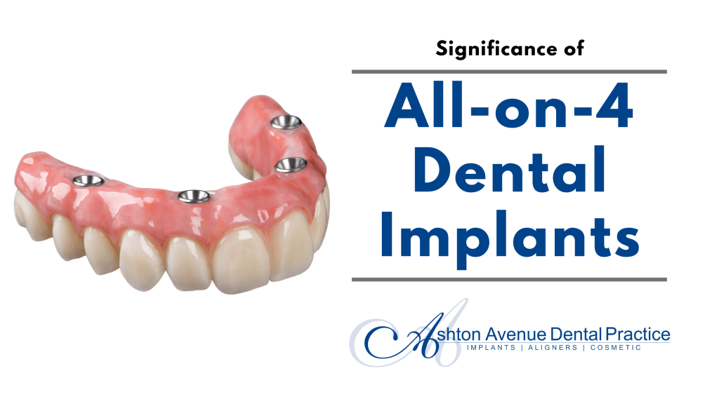 Significance of All-on-4 Dental Implants