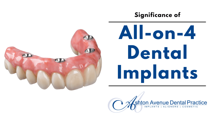 Significance of All-on-4 Dental Implants