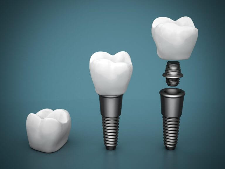 Dental-Implants-Claremont