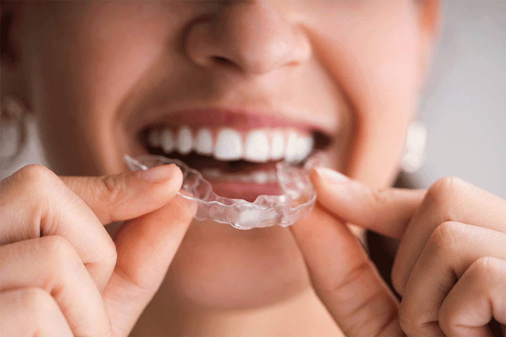clear aligners claremont, ashton avenue, dentist in claremont, childrens dentist in claremont