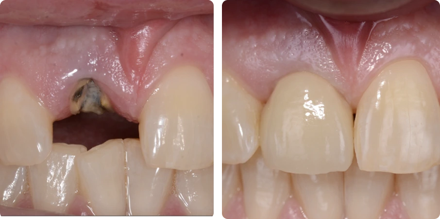 before-after-3