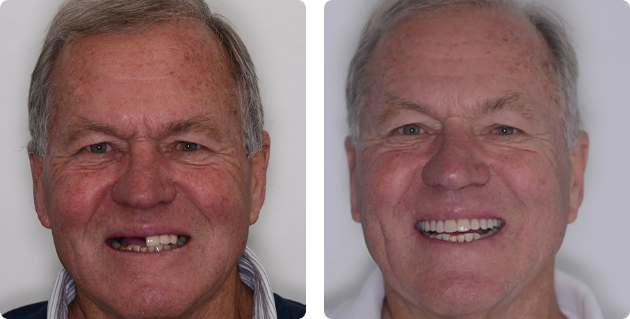 before-after-implant-2