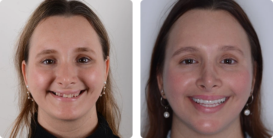 Problem: Small, Mobile and Failing teeth, Poor Aesthetics
Treatment Done: Full mouth rehabilitation with dental implants.