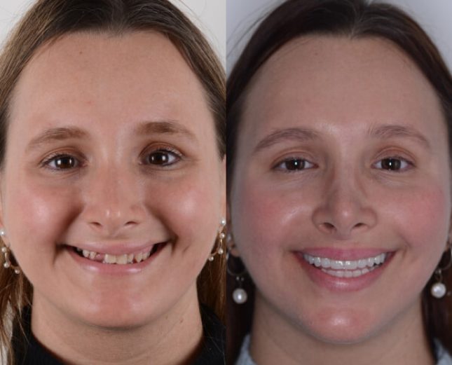 Dental veneers before and after – improved smile aesthetics